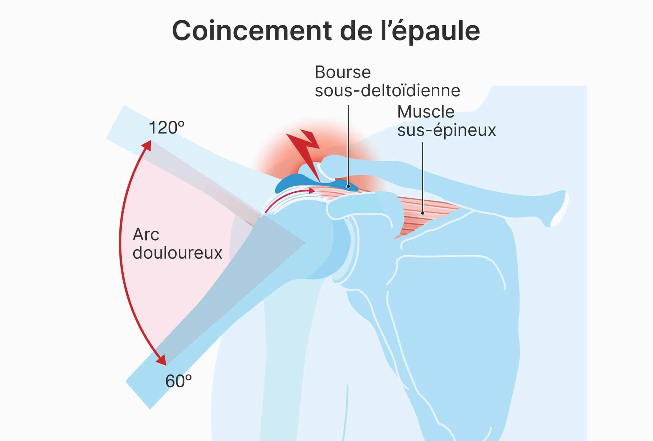 Acromioplastie de l’épaule : technique et tarif | Acromioplastie temps de récupération | Marseille | Dr Salabi