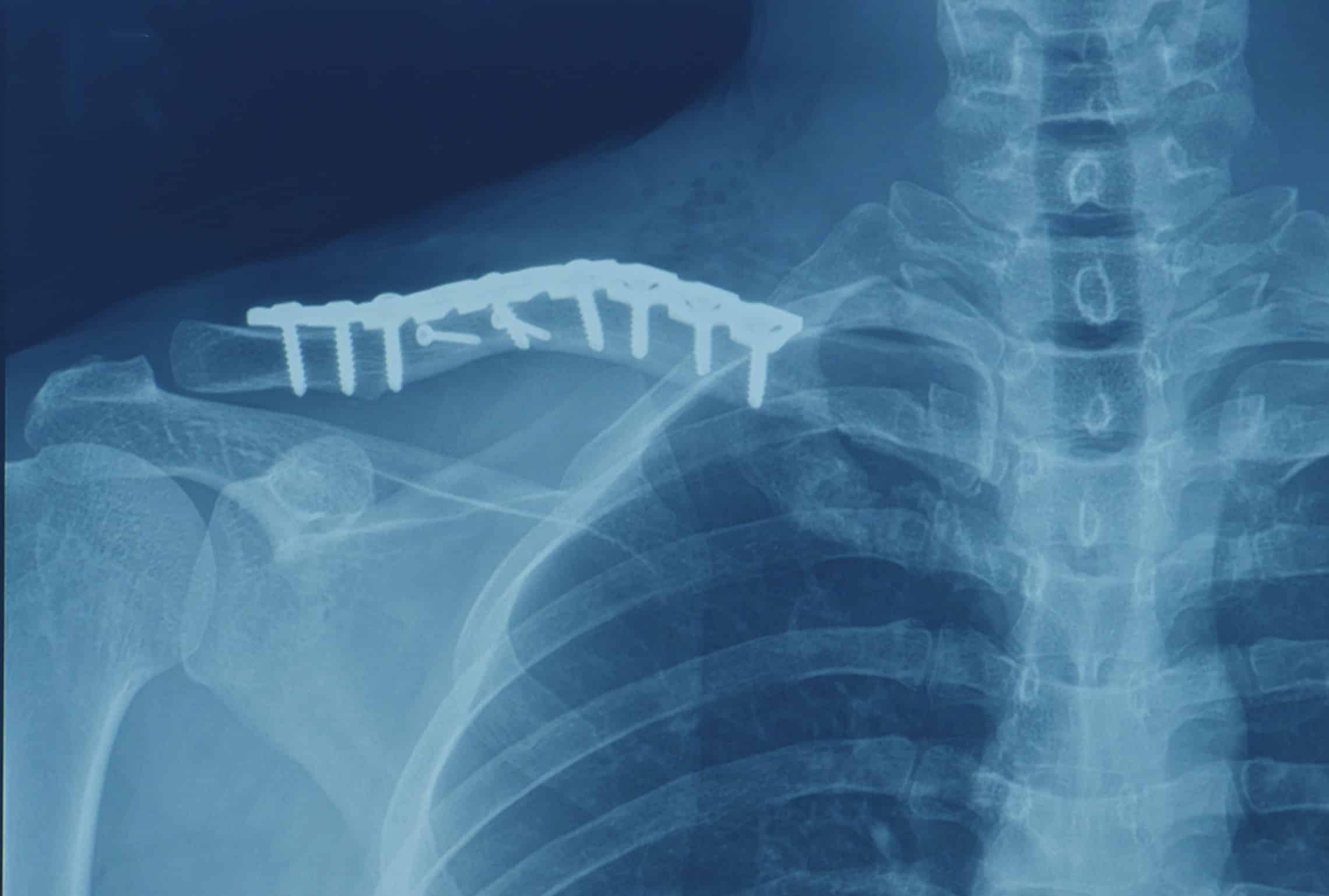 Osthéosynthèse : traitement fracture épaule | Epaule cassee traitement | Marseille | Dr Salabi