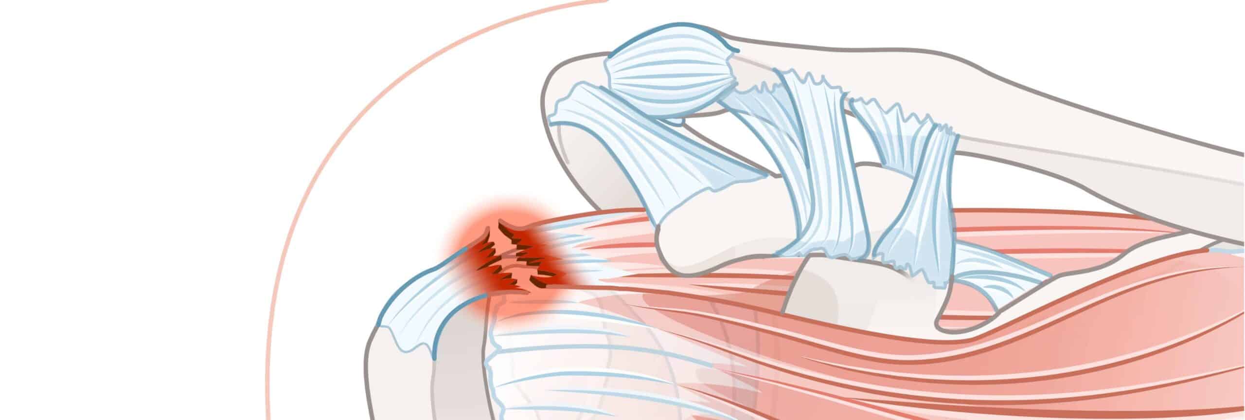 Qu’est-ce qu’une rupture dégénérative de la coiffe des rotateurs ? | Dr Dr Salabi | Marseille