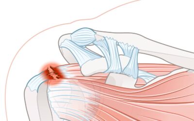 Qu’est-ce qu’une rupture dégénérative de la coiffe des rotateurs ? | Dr Dr Salabi | Marseille